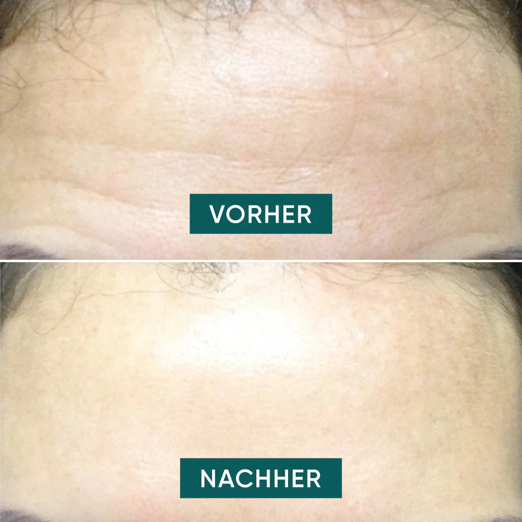 APRICOT Stirn Pad "fantastic forehead" mit Hyaluron · 30 Behandlungen – Bild 4