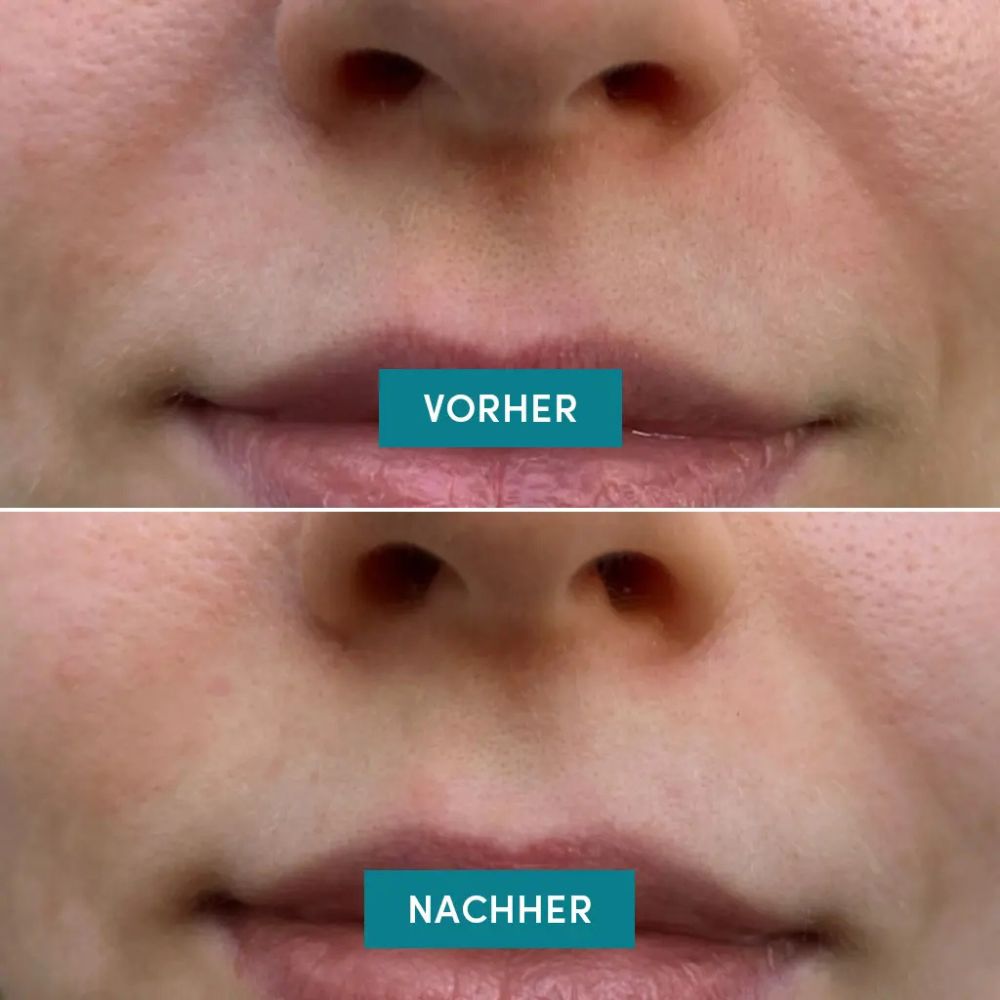 APRICOT Mund Patches mit Niacinamid · 24 Stück Minipack – Bild 4