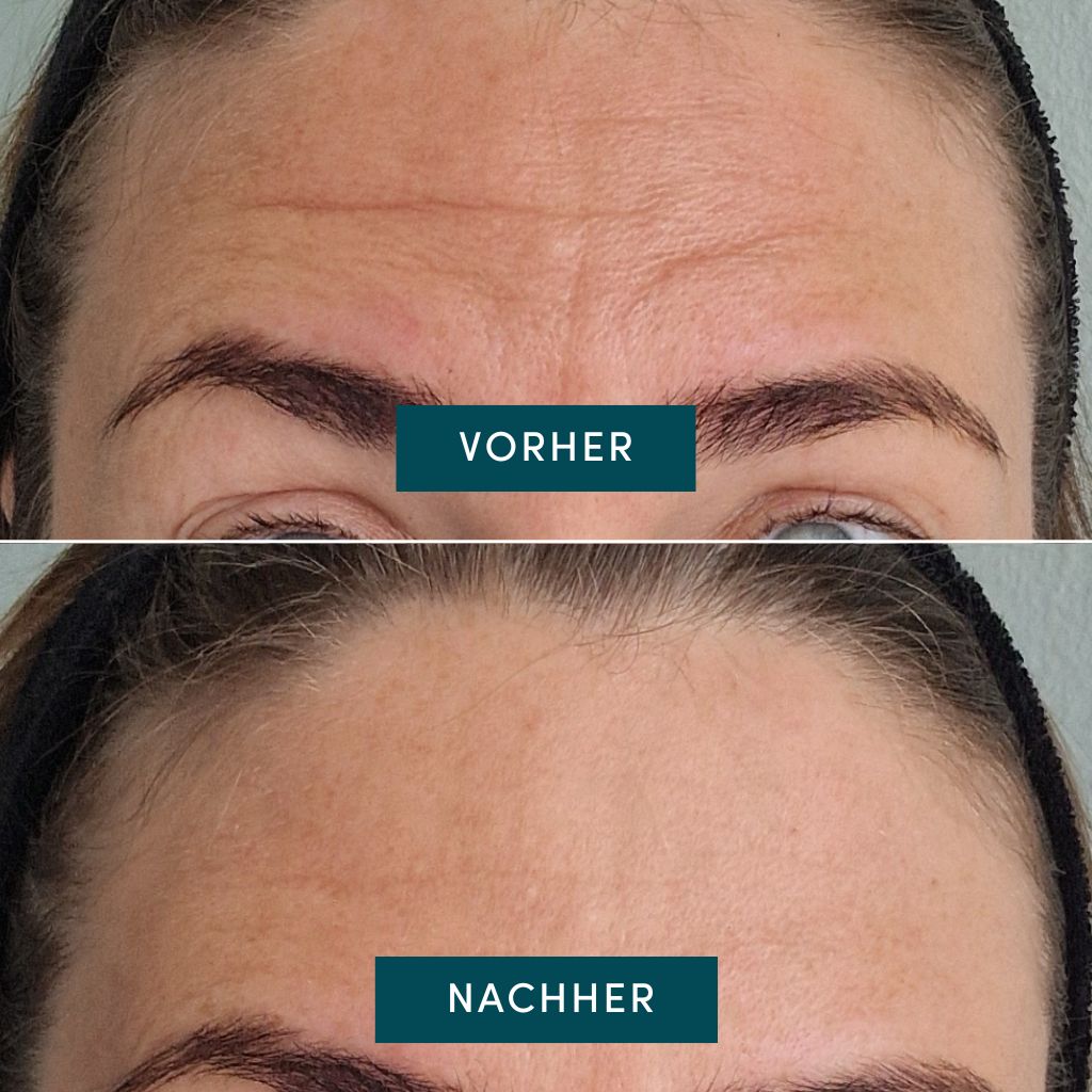 APRICOT Stirn Pad mit Aloe Vera · Wiederverwendbar · 30 Behandlungen – Bild 5
