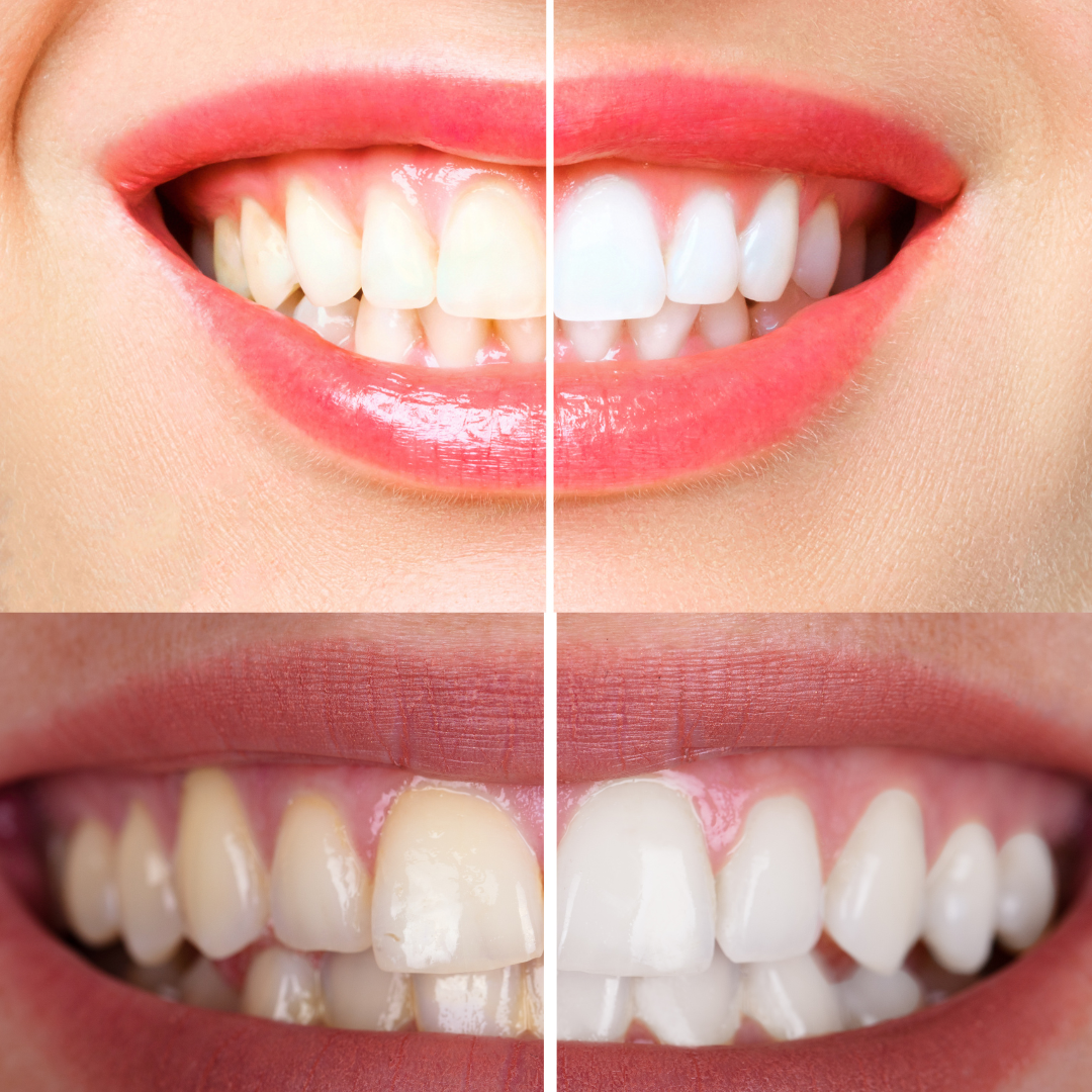 OptiSmile Colour Corrector Zahnaufhellungsstreifen · 14x2 Behandlungen – Bild 2