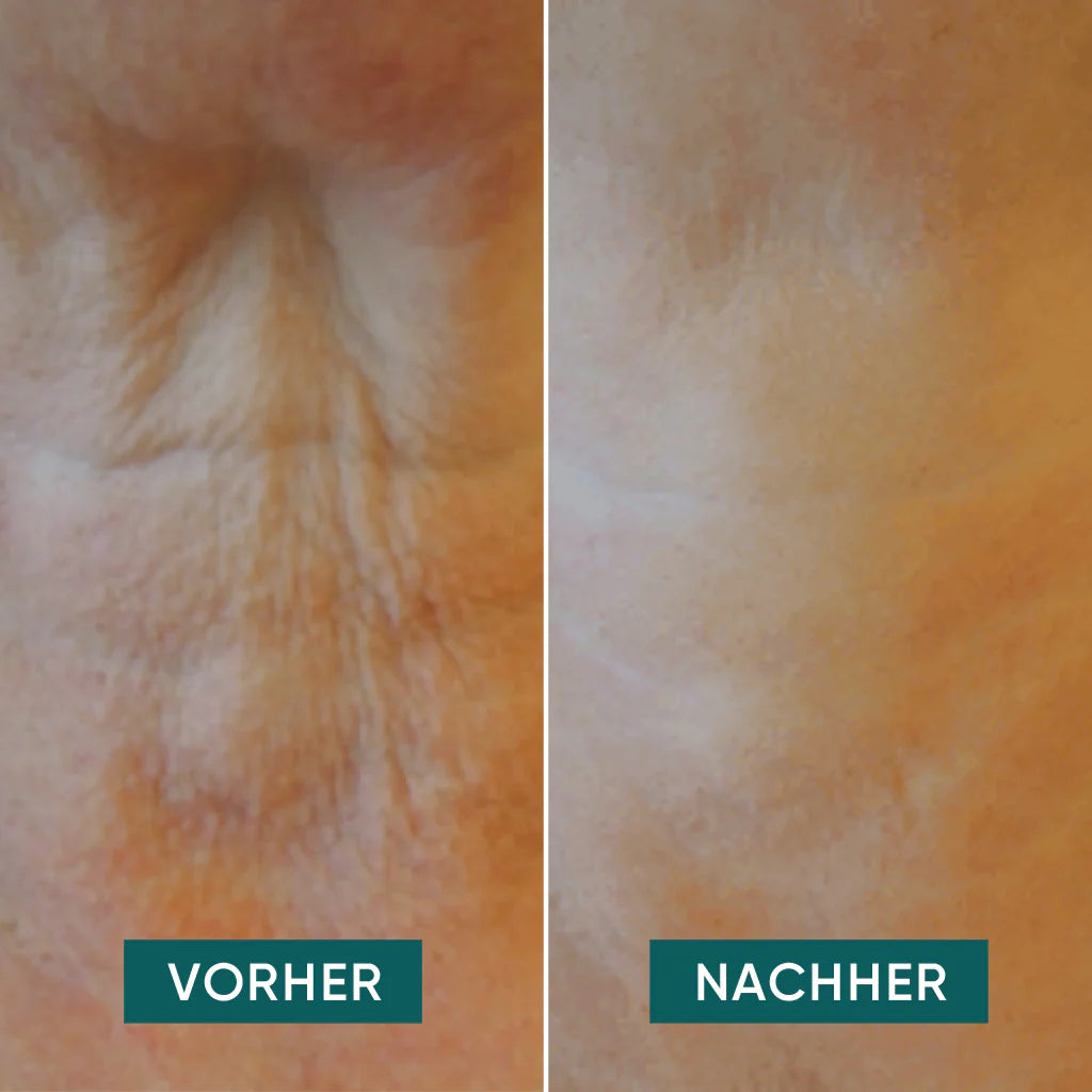 APRICOT Hals Pads "it's neck or nothing" mit Hyaluron · 30 Behandlungen – Bild 3